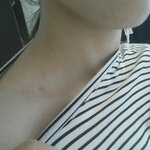 [댓글부탁해] 나 <b>쇄골</b>에 이상한 자국있어;;