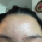 [댓글부탁해] (약혐,,)애들아 나 <b>이마에</b> 여드름 어떡해