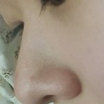 [댓글부탁해] 사진0)코 수술 할까 말까..ㅠㅠ