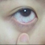 혐주의) 나 눈 <b>충혈</b>됐는데 어쩌지