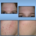 [드루와] <b>좁쌀</b>여드름 없에는법(건성)