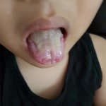 <b>입병</b>이 심한 아이에게 도움이 되었으면 하네요(약혐)(베스트 부탁드립니다)