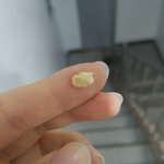 [<b>눈</b><b>갱</b>주의] 나보다 더 큰 편도결석 나와