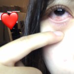 [약혐] <b>흰자</b>에 이런거 생겼는데 이거 뭐야ㅠㅠㅠㅠㅠㅠ?
