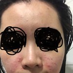 [댓글부탁해] 1주일에 뒤집어진 피부 극복했어