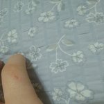 [댓글부탁해] (사진별로안징그러)<b>글루</b>건쓰다 화상입었는데 흉터남을까?