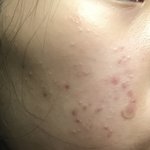 [도와줘] 나 진짜 피부과갈까ㅠㅠ(혐