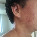 <b>피부병</b>이 너무 심해서 대인기피증까지..도와주세요ㅠㅠ