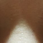 [꼭조언부탁] 쌍꺼풀 재수술 부작용..도와주세요