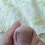 [댓글부탁해] <b>내성</b>발톱때 어떻게 제거해.. (혐주의)