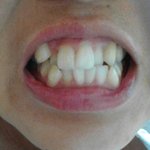 서른살 교정고민