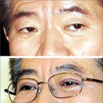 [댓글부탁해] 쌍수후기 (절개로했고,거의1년<b>차임</b>)