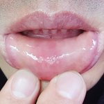 [개깊은빡침] <b>위내시경</b> 피해