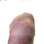[꼭조언부탁] 친정엄마가 병원에서 <b>주사</b>를 맞고 거대 멍이 들었어요.