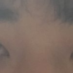 남자 <b>쌍수</b> 8일차인데 잘된거같아 ㅜㅜ?