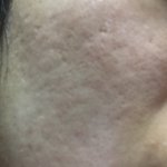 (극혐주의)이런피부로배우할수있을까요