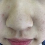 [조언부탁해] 혐주의) 나진짜 피부땜에 죽고싶어