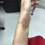 [긴급] (+수정) 억울하고 부당한 화상입은 알바생의 최후