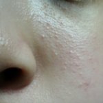 [댓글부탁해] ㅈㅂ 얼굴<b>요철</b> 없애는방법좀ㅠㅠ