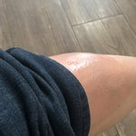 길에 있던 구멍에 빠져 다쳤습니다 ㅠ