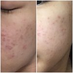 [댓글부탁해] 얘들아 내 <b>피부변화</b> 봐주라(사진ㅇ