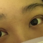 [조언부탁해] 쌍수 붓기가 안빠져 ㅠㅠ