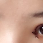 쌍수 붓기봐줘!!