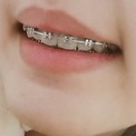 교정기 ㅈㅇ) 나 웃을때 <b>어색</b>해?