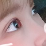 코<b>필러</b>맞을까??