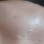 [댓글부탁해] 이런 여드름은 어떻게 없앰ㅠㅠㅠ