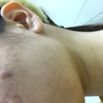 내 피부 진짜 썩었다 ? 상했다??? <b>괴사</b>했다 ㅋㅋㅋ ㅜㅜㅜ