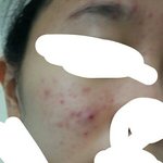 이<b>정도</b>면 <b>피부</b> 좋아진거겠지??!..ㅠㅠ