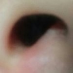 [혐주으이] 콧구멍 입구에 뾰루지남 <b>사진O</b>