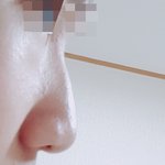 [댓글부탁해] 남자 코수술 해야겠죠?
