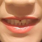 <b>이빨</b>벌어짐 출산 8개월만에 미니쉬받고 해결했네요^^