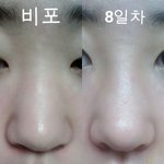 [조언부탁해] 사진유)나 코<b>수술</b> 망한것 같아...?ㅠㅠ