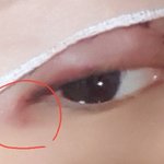 [댓글부탁해] 쌍수했는데 <b>눈</b> 뒤꼬리 빨간거왜<b>이런</b>거야