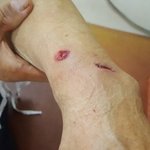 [꼭도움요청] <b>화살</b>이 팔에 관통했어요 ㅜㅜ  도와주세요. (사진첨부)