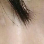 <b>짝눈</b> 어떻게 교정할까ㅜ