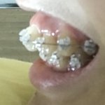 [댓글부탁해] 나교정하고 <b>앞니</b> 겁나 튀어나옴