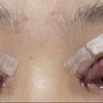-혐- <b>쌍수</b>오늘햇는데 <b>라인</b>어때