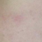 >>여드름뾰루지 홍조 <b>박멸</b> 꿀팁<<