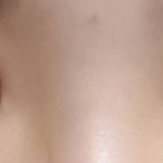 [드루와] 나 쌍수 붓기 ㅈㄴ 짝짝이였는데