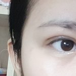앞트임 <b>흉터</b> ㅠㅠ