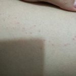 (약혐...??)허벅지 <b>양쪽</b>에 이런 빨간 게 나고 안 없어지는데...