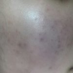 [드루와] 사진ㅇ)여드름 흉터없애는방법쓸게!