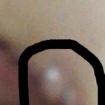 혐) 쌍수한 애들아 너네도 살 튀어나왔어?;