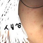 <b>피부</b> 뒤집어졌을때 <b>꿀</b>팁좀