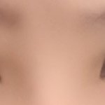 ㅠㅠ눈매교정 붓기..짝짝이..ㅠㅠ?