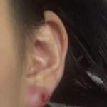 혐짤 주의_얘들아 나 귓볼 <b>염증</b>치료했어